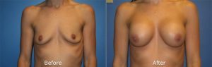 Breast Augmentation Before & After at Atagi Plastic Surgery & Skin Aesthetics in Lone Tree, CO