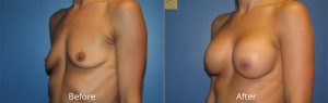 Breast Augmentation Before & After at Atagi Plastic Surgery & Skin Aesthetics in Lone Tree, CO