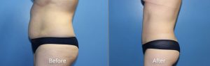 Tummy Tuck Before & After at Atagi Plastic Surgery & Skin Aesthetics in Denver, CO