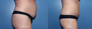 Tummy Tuck Before & After at Atagi Plastic Surgery & Skin Aesthetics in Denver, CO
