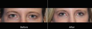 Eyelid Lift Before and After at Atagi Plastic Surgery & Skin Aesthetics in Lone Tree, CO