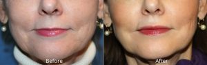 Lip Augmentation Before & After at Atagi Plastic Surgery & Skin Aesthetics in Lone Tree, CO