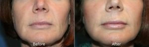 Lip Augmentation Before & After at Atagi Plastic Surgery & Skin Aesthetics in Lone Tree, CO