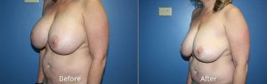 Before & After Implant Removal at Atagi Plastic Surgery & Skin Aesthetics in Denver, CO