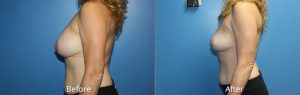 Breast Implant Removal & Replacement Before & After Photos in Denver, CO