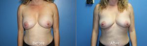 Breast Implant Removal & Replacement Before & After Photos in Denver, CO