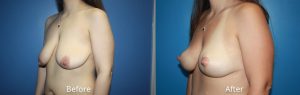 Breast Lift Before & After Photos at Atagi Plastic Surgery & Skin Aesthetics in Denver, CO