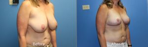 Breast Reduction before & after at Atagi Plastic Surgery & Skin Aesthetics Lone Tree, CO