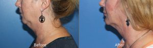 Chin Augmentation with Liposcution of Neck Before & After at Atagi Plastic Surgery & Skin Aesthetics in Lone Tree, CO