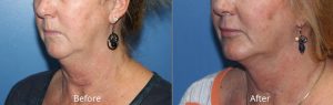 Chin Augmentation with Liposcution of Neck Before & After at Atagi Plastic Surgery & Skin Aesthetics in Lone Tree, CO