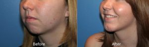 Chin Augmentation Before& After at Atagi Plastic Surgery & Skin Aesthetics in Lone Tree, CO
