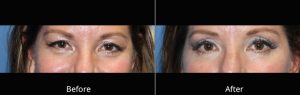 Eyelid Lift Before and After at Atagi Plastic Surgery & Skin Aesthetics in Lone Tree, CO