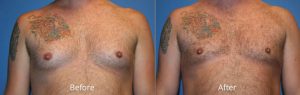 Male Chest Reduction Before & After at Atagi Plastic Surgery & Skin Aesthetics in Lone Tree, CO
