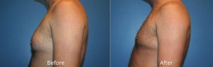 Male Chest Reduction Before & After at Atagi Plastic Surgery & Skin Aesthetics in Lone Tree, CO