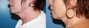 Necklift Before & After at Atagi Plastic Surgery & Skin Aesthetics in Lone Tree, CO