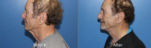 Necklift with Mid Facelift Before & After at Atagi Plastic Surgery & Skin Aesthetics in Lone Tree, CO
