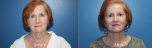 Necklift with Lower Facelift Before & After at Atagi Plastic Surgery & Skin Aesthetics in Lone Tree, CO