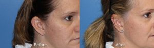Ear Refinement Before & After Photos at Atagi Plastic Surgery & Skin Aesthetics in Lone Tree, CO