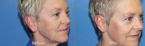 Repaired Torn Earlobe Before & After Photo at Atagi Plastic Surgery & Skin Aesthetics in Lone Tree, CO