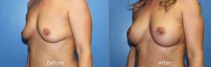 Breast Augmentation Before & After at Atagi Plastic Surgery & Skin Aesthetics in Lone Tree, CO (34 B to 34 C)