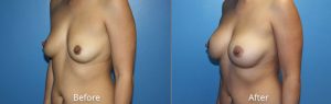 Breast Augmentation Before & After at Atagi Plastic Surgery & Skin Aesthetics in Lone Tree, CO (34 A to 34 C)