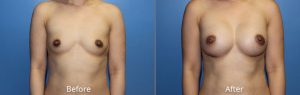 Breast Augmentation Before & After at Atagi Plastic Surgery & Skin Aesthetics in Lone Tree, CO (32 AA to 32 C)