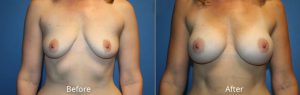 Breast Augmentation Before & After at Atagi Plastic Surgery & Skin Aesthetics in Lone Tree, CO (32 B to 32 DD)