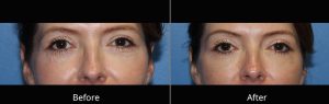 Dermal Filler Under the Eyes Before & After at Atagi Plastic Surgery Skin Aesthetics in Lone Tree, CO