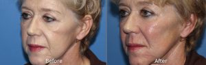 Dermal Filler Before & After at Atagi Plastic Surgery Skin Aesthetics in Lone Tree, CO
