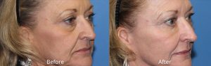 Dermal Filler Before & After at Atagi Plastic Surgery Skin Aesthetics in Lone Tree, CO