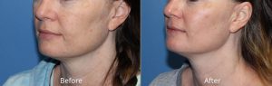 Micro-Needling Before & After at Atagi Plastic Surgery & Skin Aesthetics in Lone Tree, CO