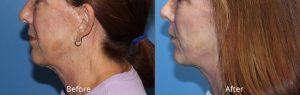 Micro-Needling Before & After at Atagi Plastic Surgery & Skin Aesthetics in Lone Tree, CO