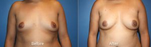Natural Breast Augmentation Before & After at Atagi Plastic Surgery & Skin Aesthetics in Lone Tree, CO