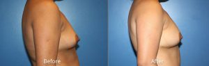 Natural Breast Augmentation Before & After at Atagi Plastic Surgery & Skin Aesthetics in Lone Tree, CO