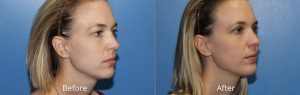 Ultherapy Before & After at Atagi Plastic Surgery & Skin Aesthetics in Lone Tree, CO
