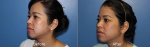 Chemical Peel Before & After at Atagi Plastic Surgery & Skin Aesthetics in Denver, CO