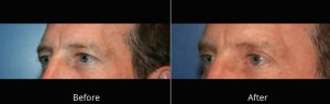 Eyelid Lift Before & After at Atagi Plastic Surgery & Skin Aesthetics in Denver, CO