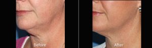 Ultherapy Neck Before & After at Atagi Plastic Surgery & Skin Aesthetics in Lone Tree, CO