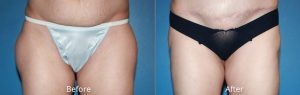 VASER Lipo on Outer Thighs Before & After at Atagi Plastic Surgery & Skin Aesthetics in Denver, CO