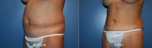 VASER Lipo on Abdomen Before & After at Atagi Plastic Surgery & Skin Aesthetics in Denver, CO