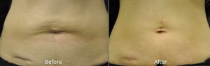 Before & After Photos of Exilis Skin Tightening Not Actual Patients of Dr. Atagi