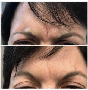 Botox before & after photo at Atagi Plastic Surgery & Skin Aesthetics in Lone Tree, CO
